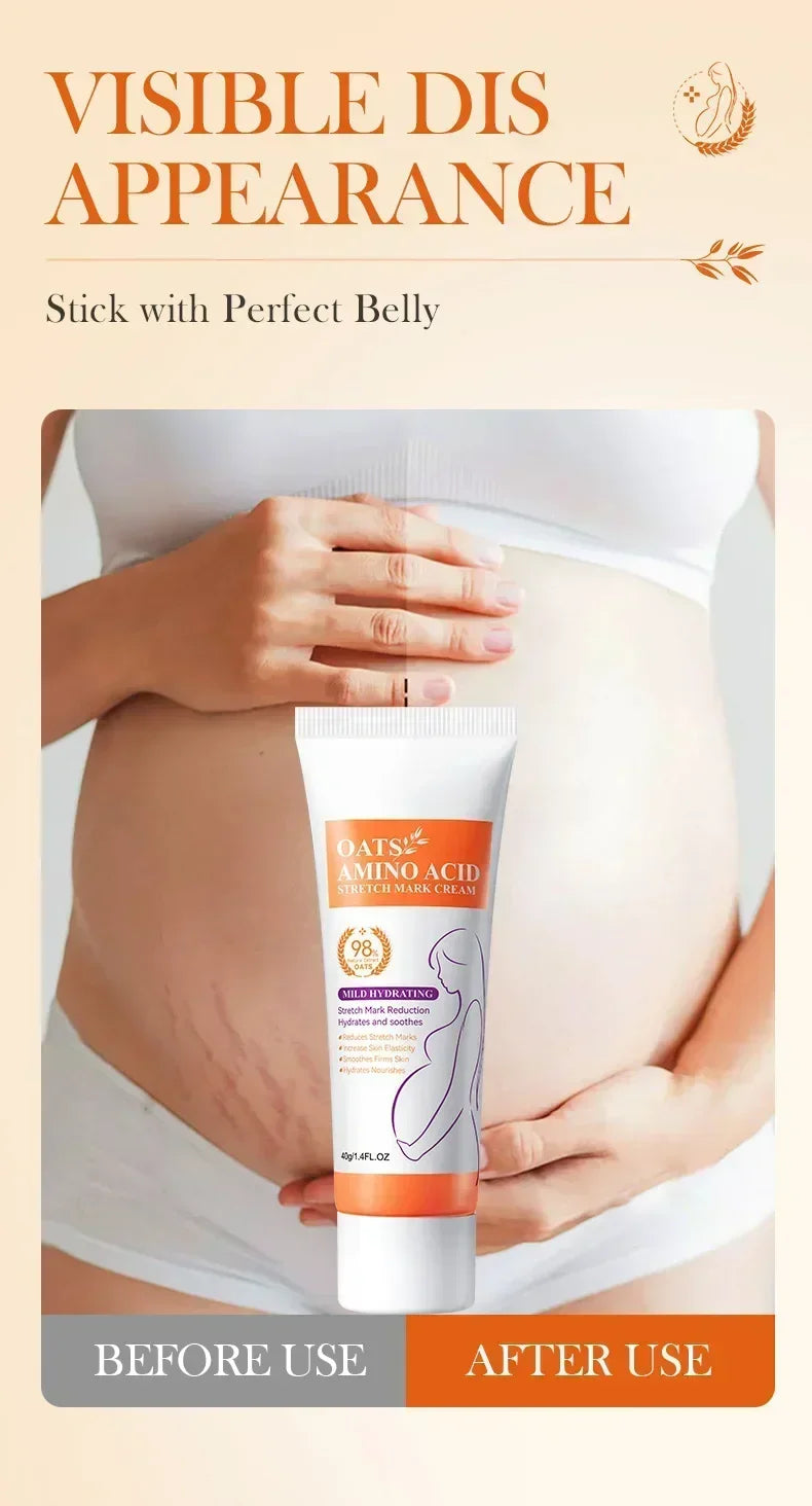 MaternGlow™: Stretch Mark Removal Cream 🤰💖✨